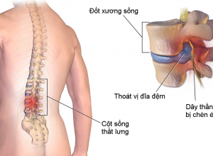 Thoát vị đĩa đệm cột sống thắt lưng bệnh học {Tổng quan chi tiết về bênh}